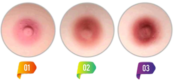 Areola Color